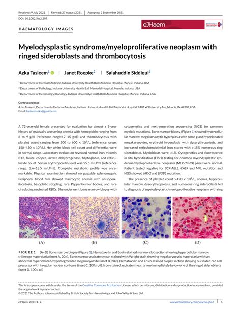 pdf myelodysplastic syndrome myeloproliferative neoplasm with ringed sideroblasts and