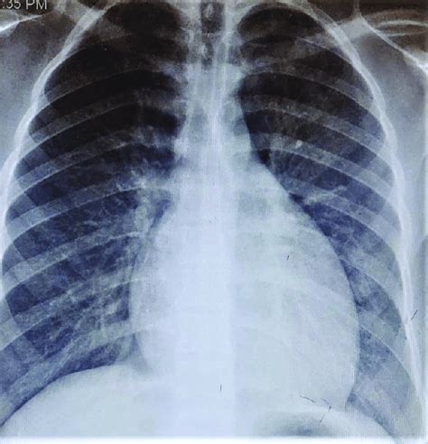 Mild Cardiomegaly On Anterior Posterior Chest Radiograph Source