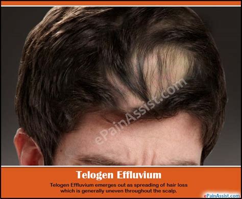 The Itchy And Burning Scalp Telogen Effluvium Justinboey