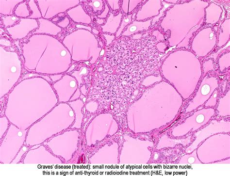 We did not find results for: Pathology Outlines - Graves disease