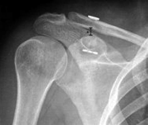 Management Of Acute Acromioclavicular Joint Dislocation With A Double