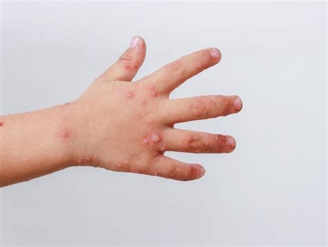 Premium Photo Red Rash On Baby Hands Hand Foot And Mouth Disease Hfmd