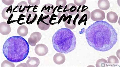 Acute Myeloid Leukemia Aml W Monocytic Differentiation Formerly