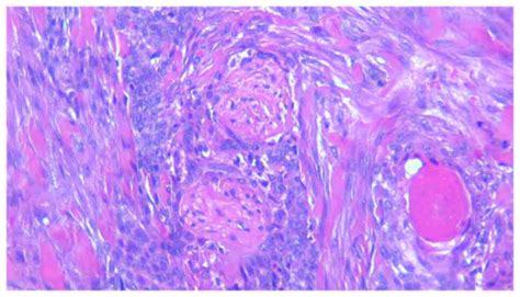 Basal Cell Carcinoma Pattern
