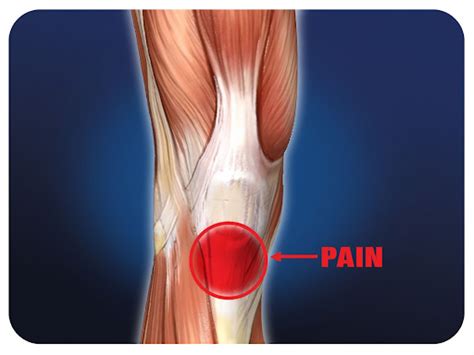 Dry Needling For Knee Pain Jumpers Knee Patellar Tendonitis
