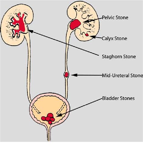 Pdf Physiopathology And Etiology Of Stone Formation In The Kidney And