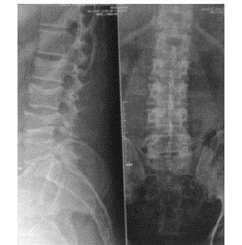 Plain Anteroposterior And Lateral Radiographs Of The Lumbosacral Spine