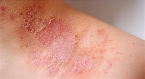 Moisture Associated Skin Damage Masd Prevention And Treatments