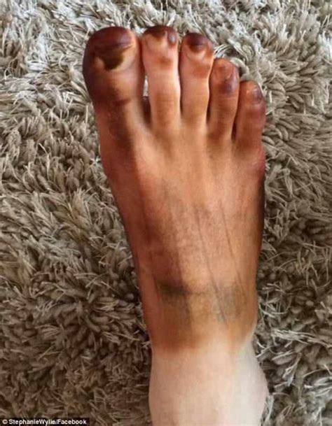 This Dad Was Terrified When His Foot Turned Black Overnight But The