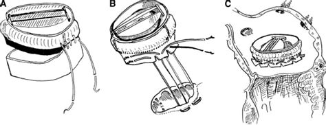 A Novel Technique Of Supra Annular Mitral Valve Replacement The