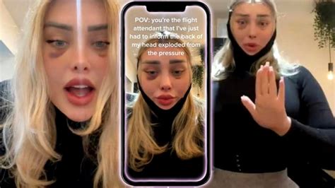 Onlyfans Model Says Her Head Exploded During A Plastic Surgery Vrogue