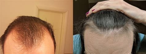 Then, old hairs fall out to allow new ones to grow in. MtF, 30, 1 year HRT + finasteride + minoxidil + biotin ...