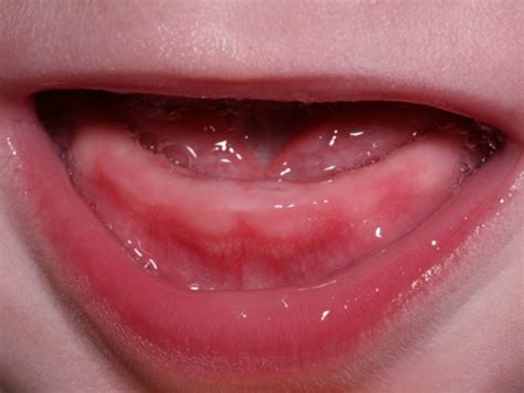 Teething Photo Of The Gums How Teeth Are Cut What The Mouth Looks