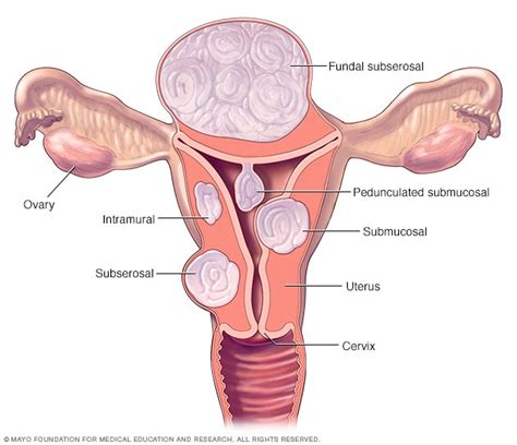 Overview Uterine Fibroids Mayo Clinic