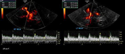 Transcranial Doppler Sonographic Tendencies Vascular Ultrasound