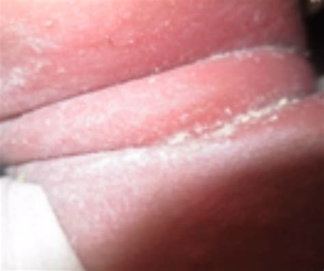 intertrigo pictures rash symptoms causes treatment hubpages