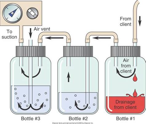 How A Chest Tube Drainage System Works Sinai Em