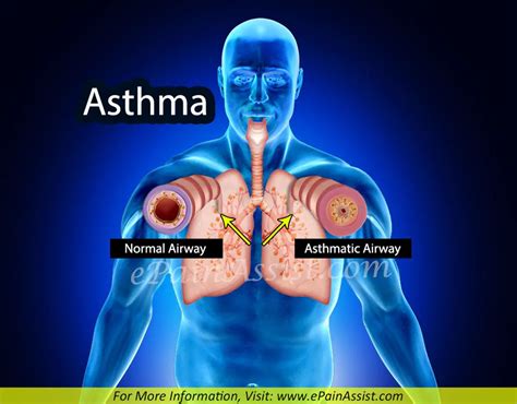 Asthma Treatment Home Remedies Prevention Symptoms