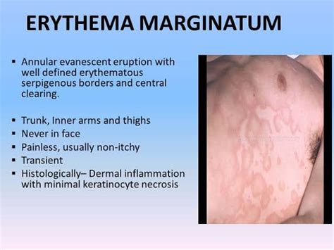 Erythema Marginatum Vs Erythema Multiforme