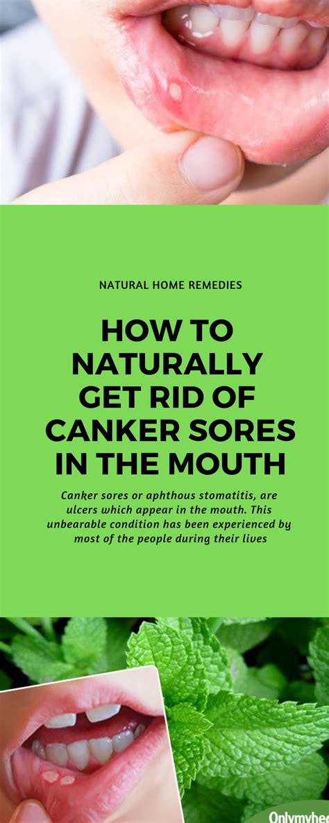 How To Naturally Get Rid Of Canker Sores In The Mouth Canker Sore
