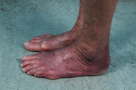 Asymmetric Red Bluish Foot Due To Acrodermatitis Chronica Atrophicans