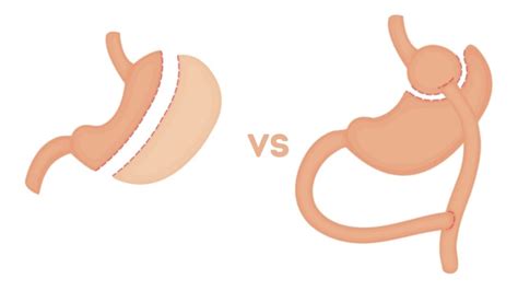 Gastric Sleeve Vs Gastric Bypass What’s The Difference