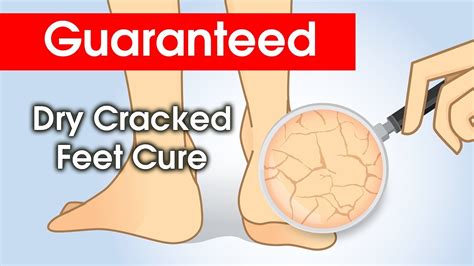 Dry Cracked Feet How To Cure Youtube