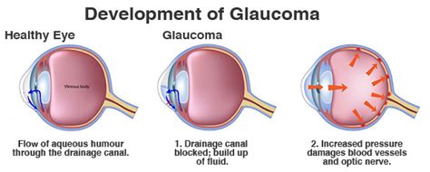 It can occur at if glaucoma is recognized early, vision loss can be slowed or prevented. Diagnosed With Glaucoma? It's Not The End Of The World ...