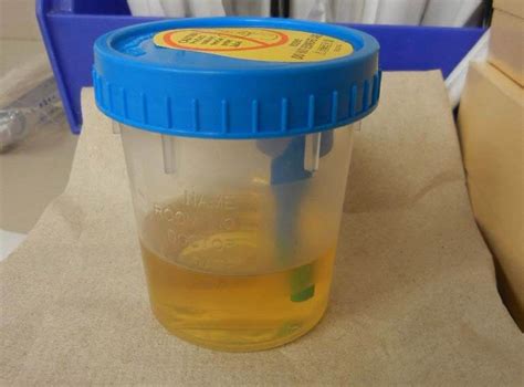 Urine Luck Using Urine As A Diagnostic Tool