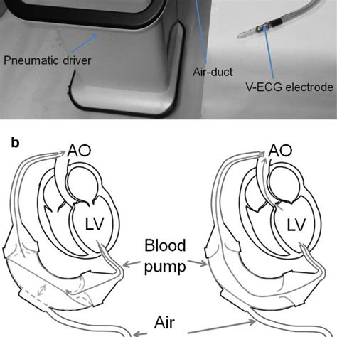 Libraheart I Pulsatile Lvad System A And Its Operating Mechanism