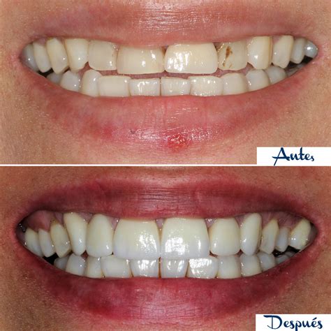 Antes y después de un tratamiento de estética dental