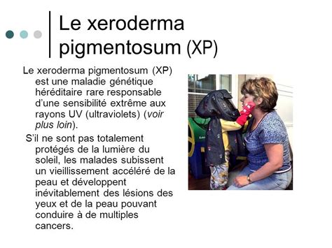Origine Et Mecanisme Du Xeroderma Pigmentosum