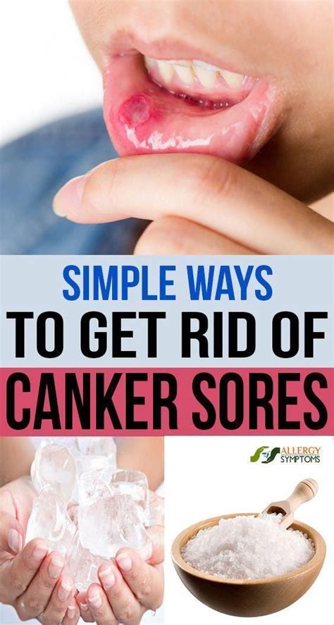 Simple To Get Rid Of Canker Sores Precious Health