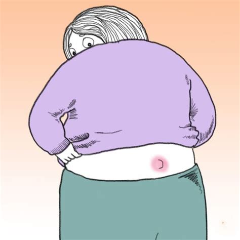 If You Find A Pimple At The Top Of Your Butt Crack It May Actually Be A Pilonidal Cyst Us