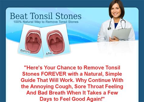 Natural Remedies For Tonsil Stones How “beat Tonsil Stones” Helps