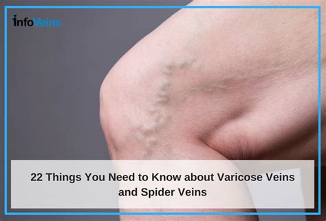 Varicose Veins And Spider Veins 22 Things You Need To Know