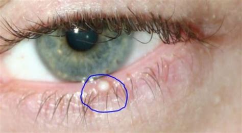 An Eyelid Pimple Stye Milia Chalazion Or Whitehead Skincarederm