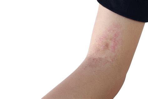 Dermatophytose Définition Et Traitement Contre La Dermatophytose