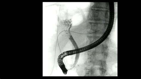 Eus Guided Rendezvous Technique For Refractory Benign Biliary Stricture
