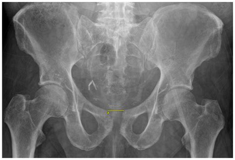 Jbji Orthopedic Management Of Pubic Symphysis Osteomyelitis A Case
