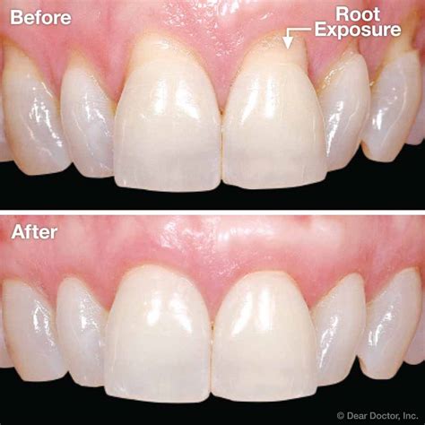 Gingival Gum Grafting Coastal Periodontics Implant Dentistry Mobile Alabama