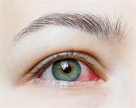 Pink Eye Treatment In Orange County Ca Fccmg