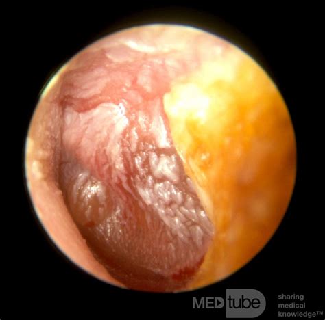 Severe Acute Otitis Media With Infected Tympanic Membrane • Picture