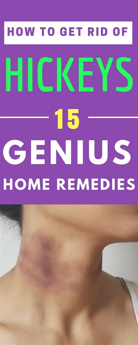 how to get rid of a hickey quick here are 15 proven ways to get rid of a hickey fast overnight