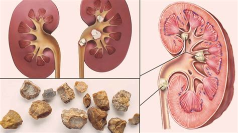 Learn The Ways Of How To Get Rid Of Kidney Stones