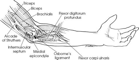 Cubital Tunnel Syndrome Musculoskeletal Key