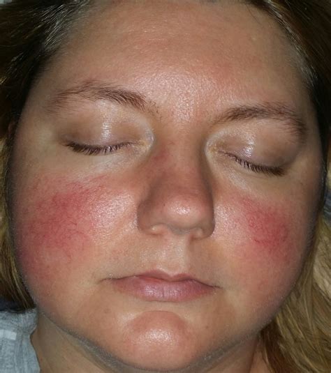 Is It Rosacea Rosacea And Facial Redness By Trishmariep