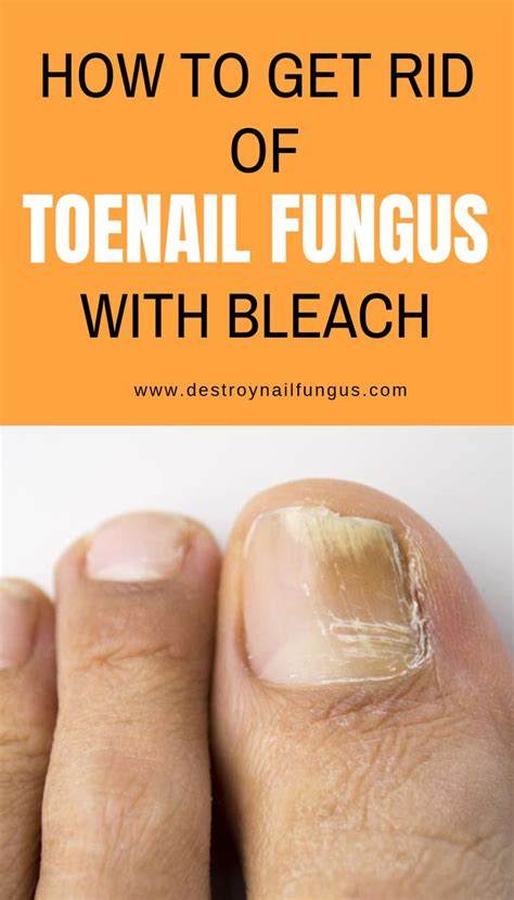 A fungal infection of the skin is also known as athletes foot which causes itching burning and flaking. Bleach is one of the most common household ingredients. Recently, a new trend has emerged where ...