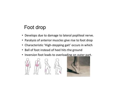 Foot Drop