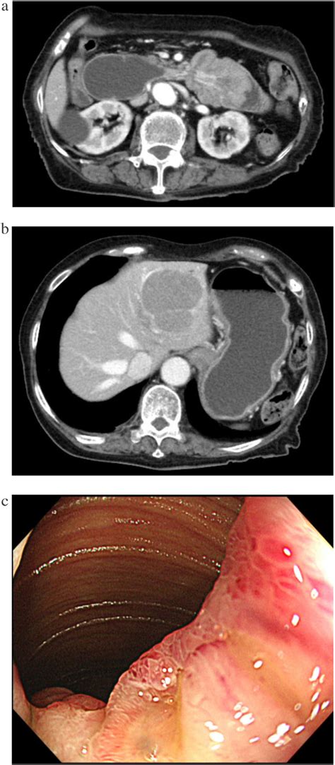 A Findings On Contrast Enhanced Computed Tomography Intussusception